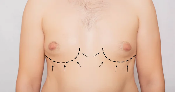 Gynecomastia (Man Boobs): What You Need to Know
