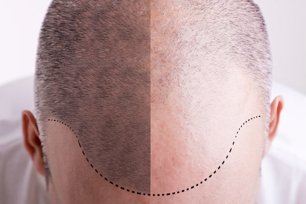 How much Does a Hair Transplant in Turkey Cost-lerra clinic