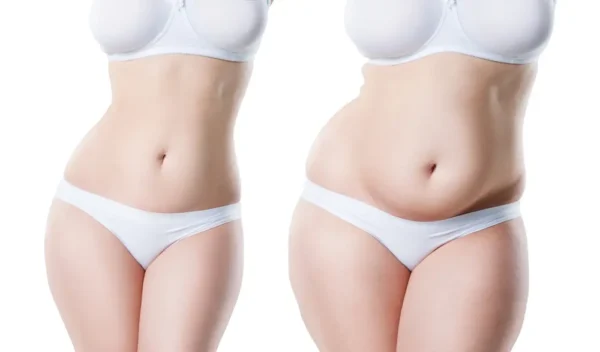 Types of Liposuction Techniques in Turkey - Lerra Clinic