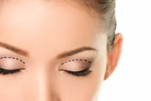 Blepharoplasty (Eyelid Surgery) in Turkey - Lerra Clinic