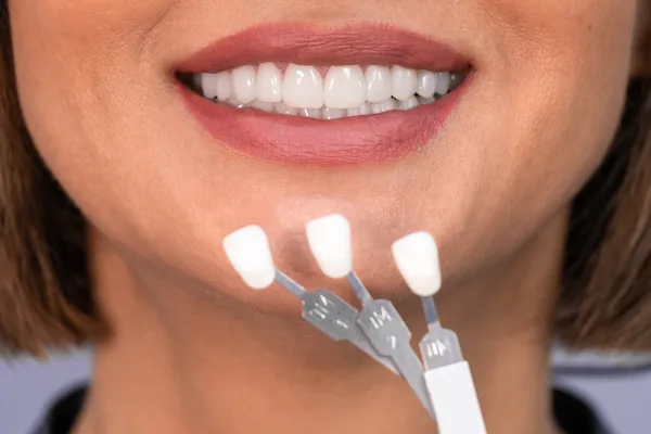 A doctor offered veneer options to improve a patient's smile.