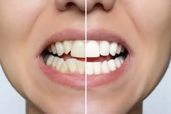 Young woman's smile before and after installing Direct Veneering Technique