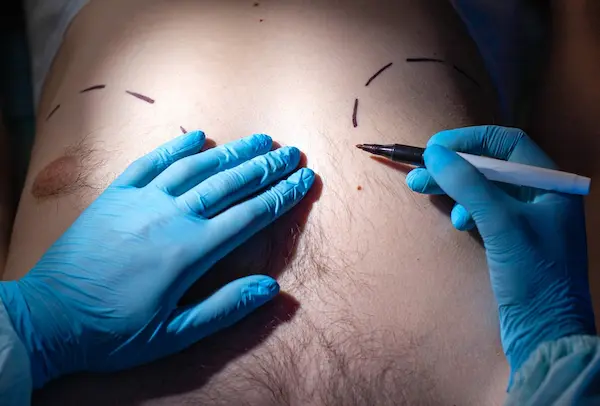 man boobs surgery in Turkey