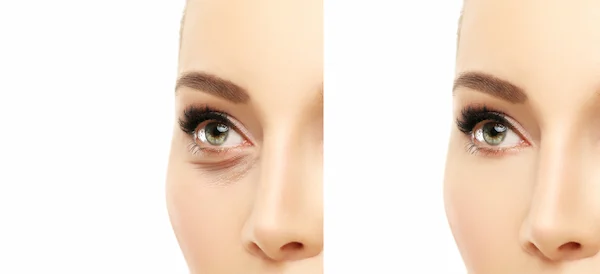before and after Lower Blepharoplasty in Turkey