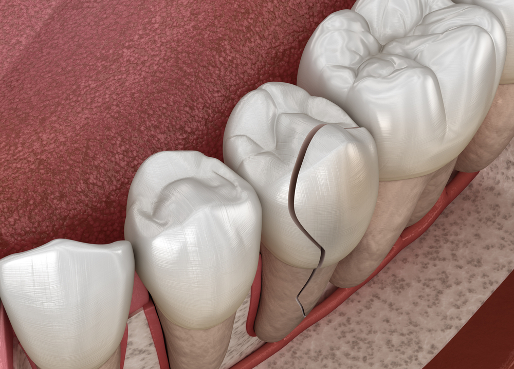 Cracked, split teeth treated through veneers