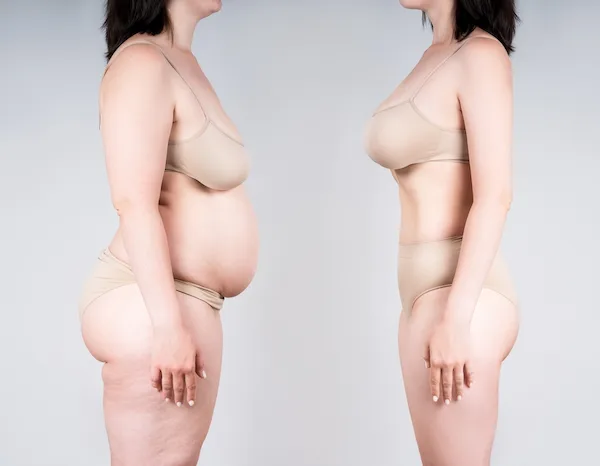 Complete Guide to Liposuction for Women