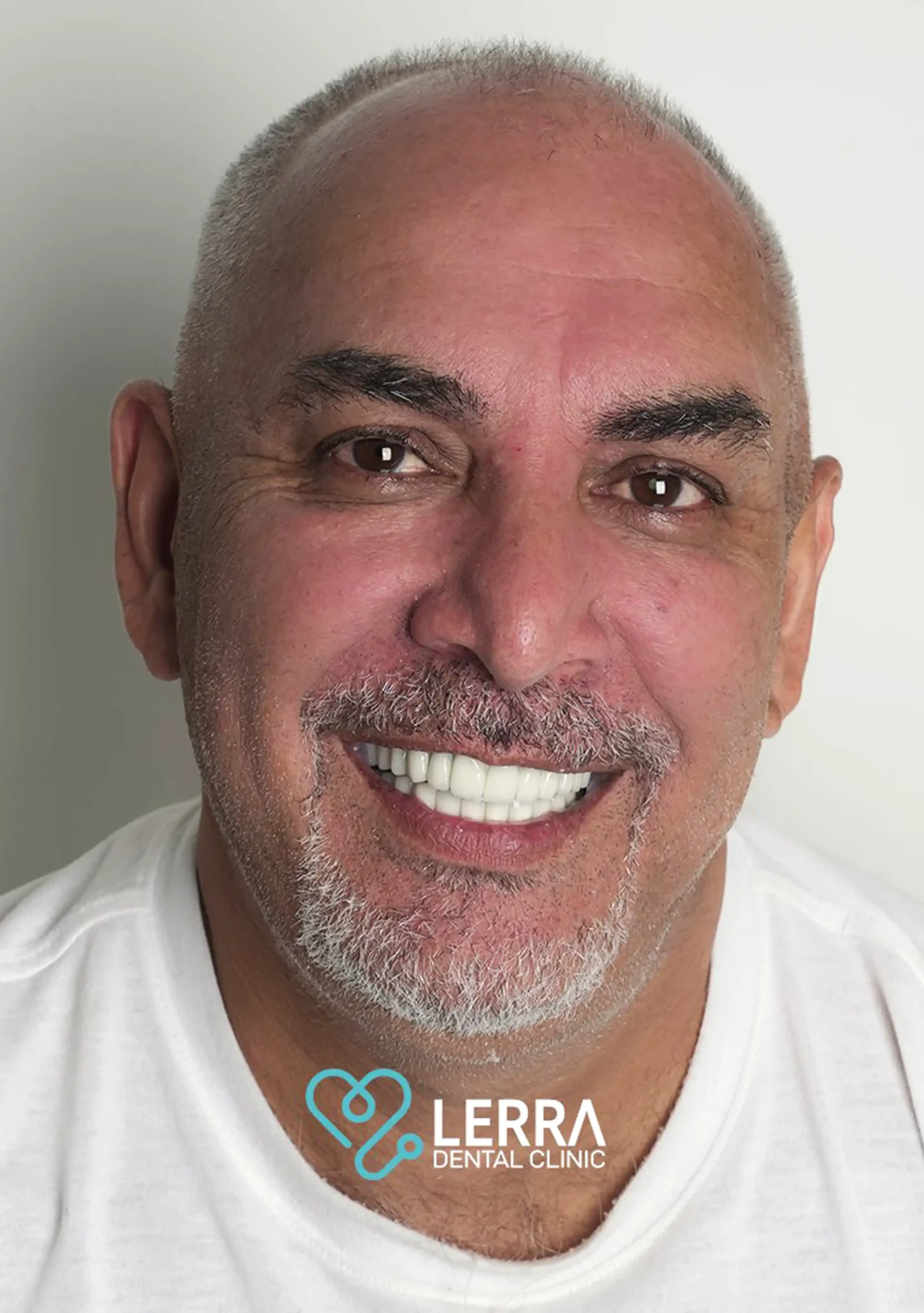 Hollywood Smile in Istanbul - at Lerra Clinic