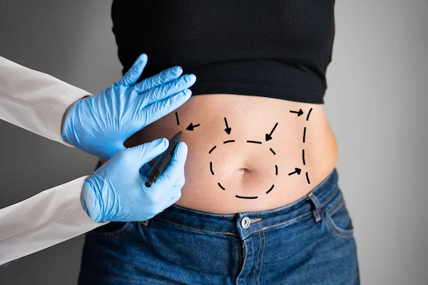  Liposuction in Turkey