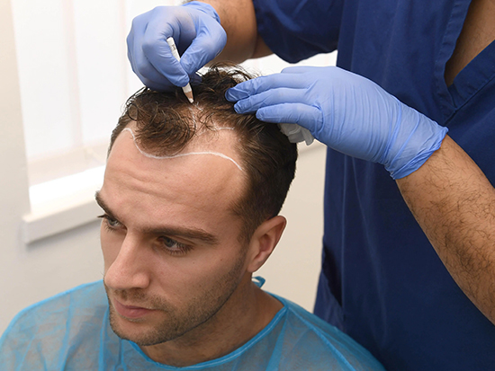 Preparing for Hair Transplant in Turkey