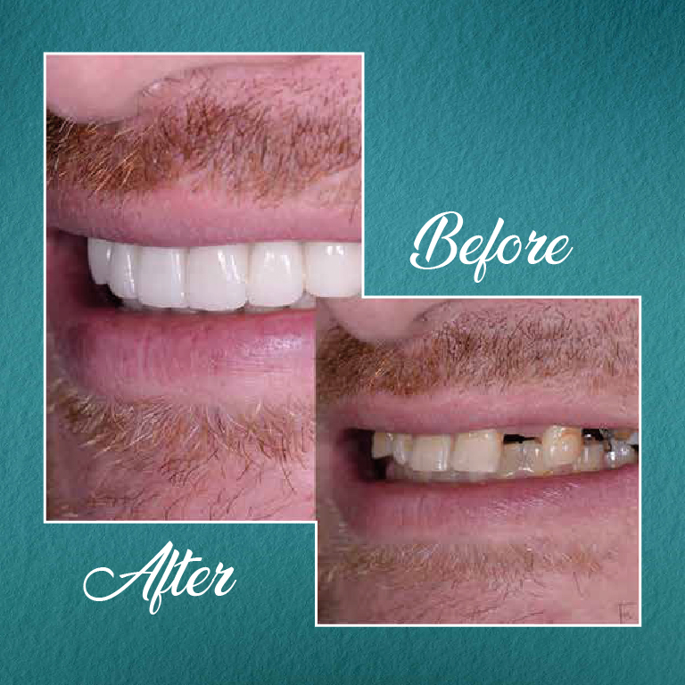 Full Mouth Dental Implants