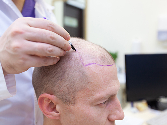 Preparing for Hair Transplant in Turkey