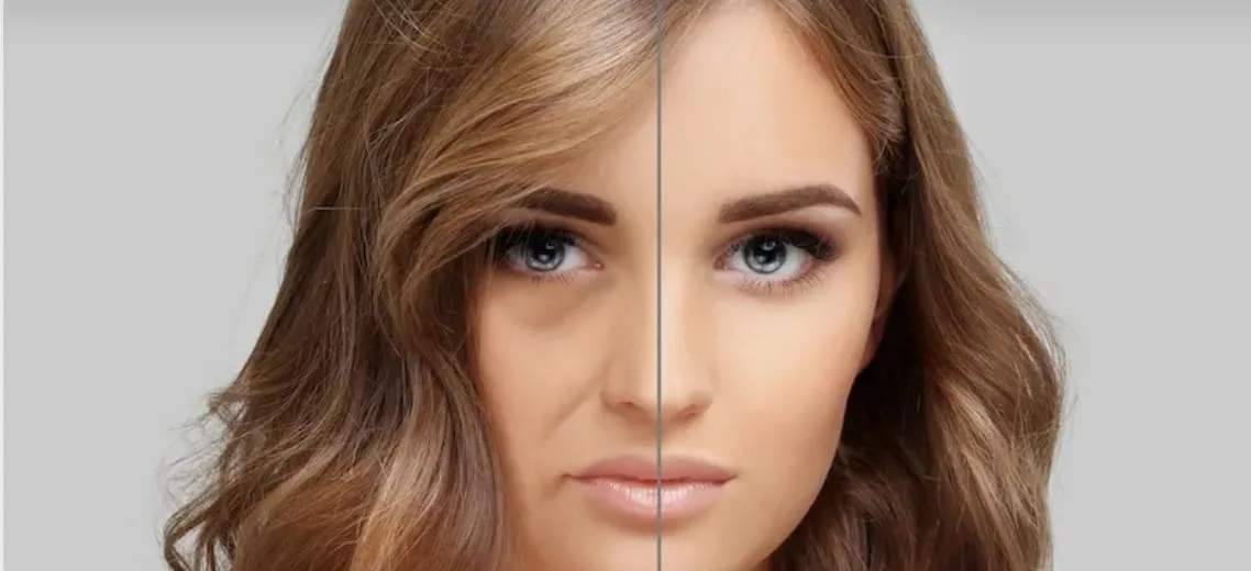 Lower Blepharoplasty