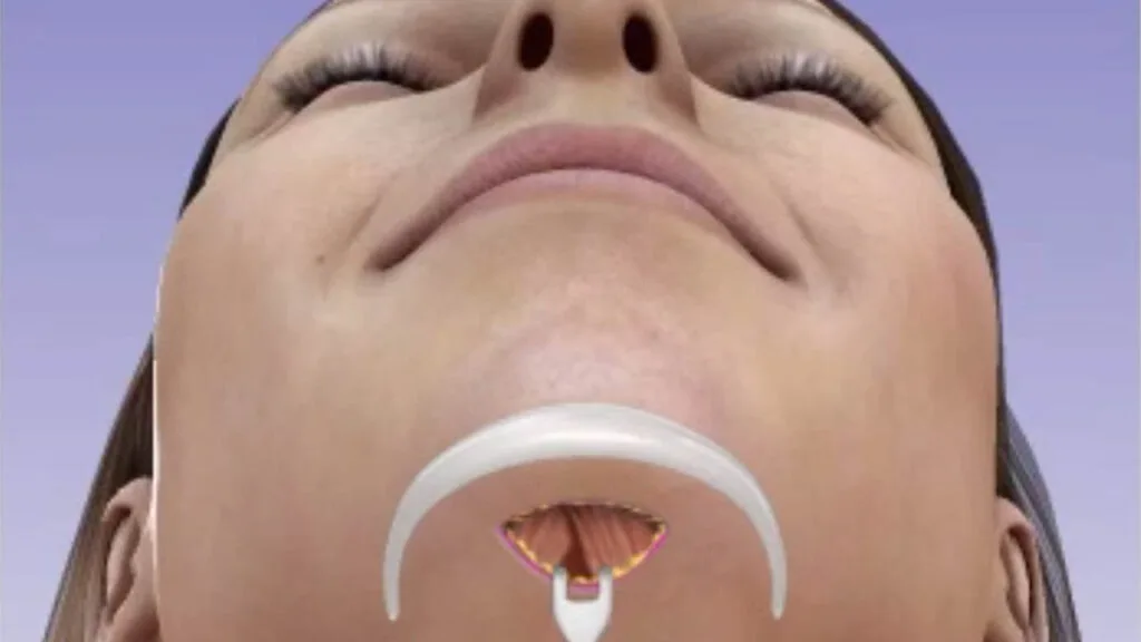 How does a chin implant work