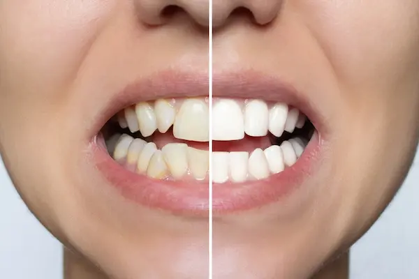 How Long do Veneers Take to Heal?