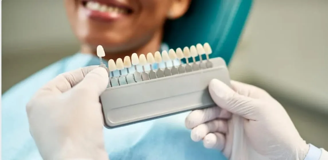 How Long do Veneers Take to Heal?