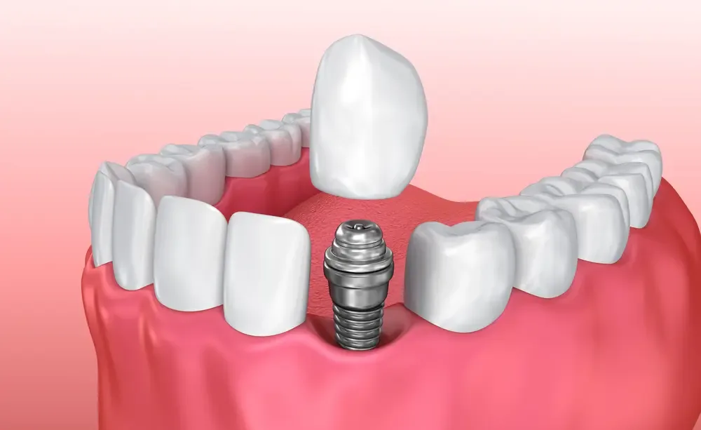 Dental Implants