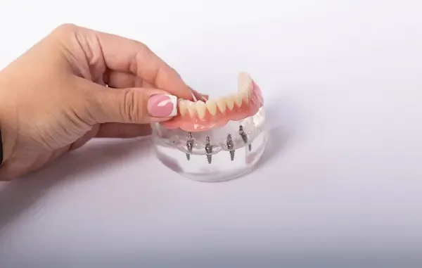 Dental Implants