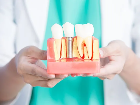 Dental Implants