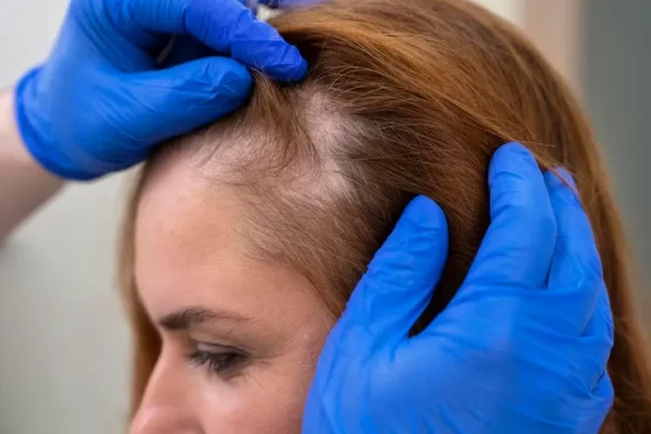 عملية زراعة الشعر بتقنية السفير