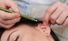 Otoplasty in Turkey, İstanbul