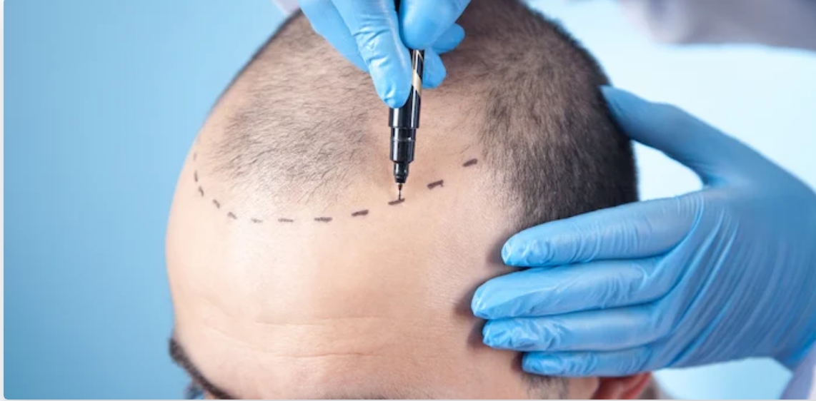 Preparing for Hair Transplant in Turkey