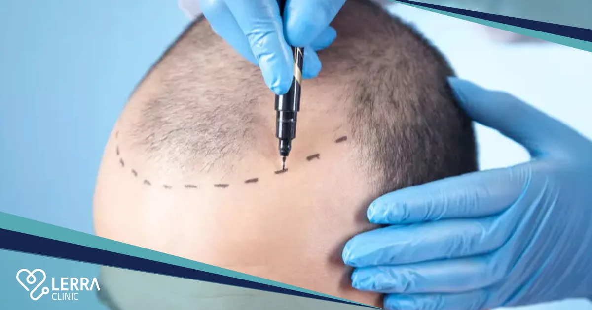 Sapphire Hair Transplant Turkey