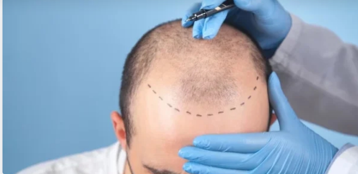 Sapphire Hair Transplant