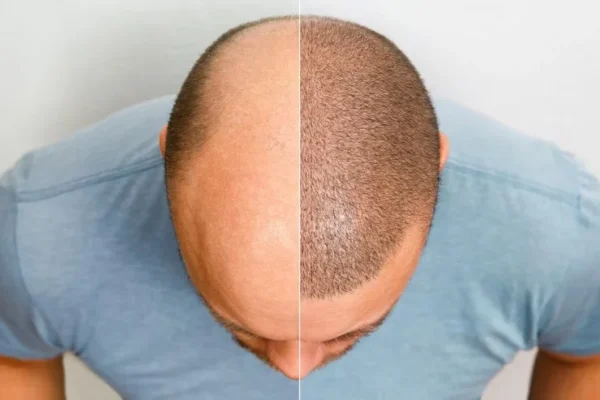 Sapphire Hair Transplant