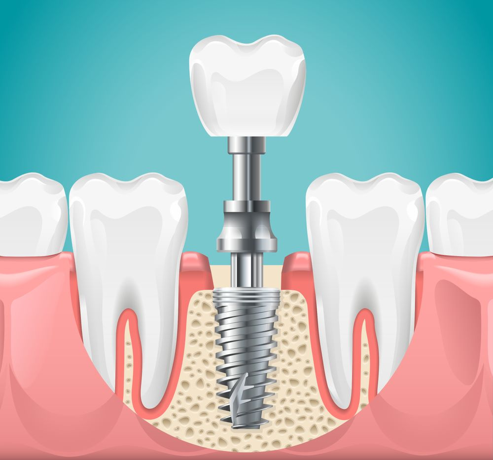 Dental Implants in Turkey