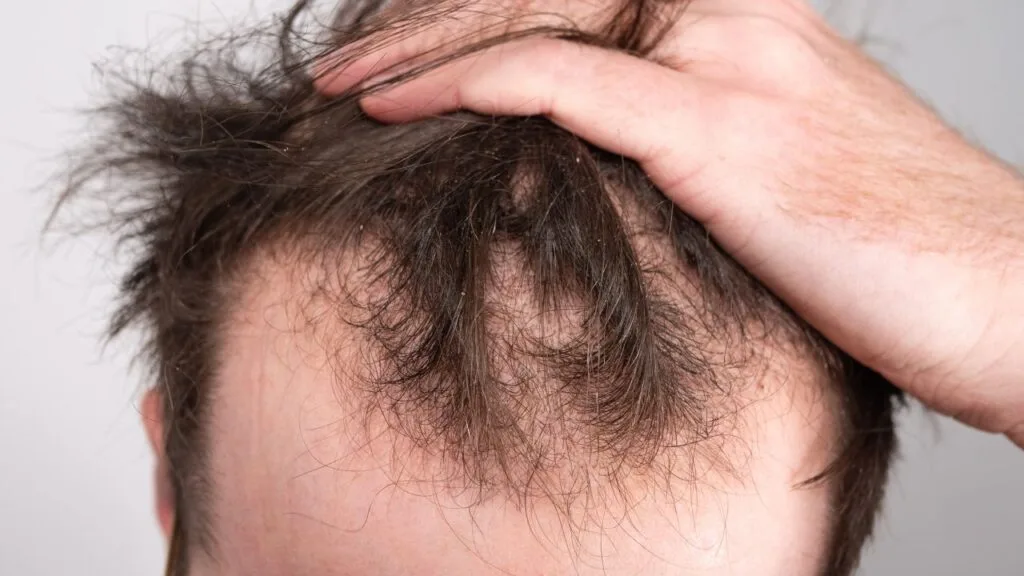 Hair Transplant Services for Men and Women