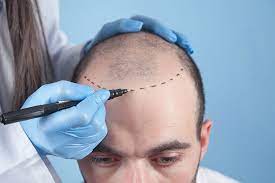 خدمات زراعة الشعر الشاملة