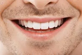 أفضل إجراءات تجميل الأسنان