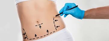 Vaser Liposuction in Turkey