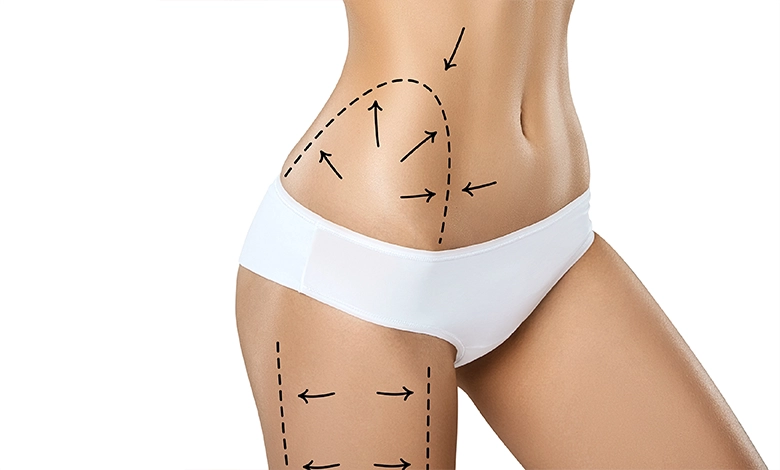 Vaser Liposuction in Turkey