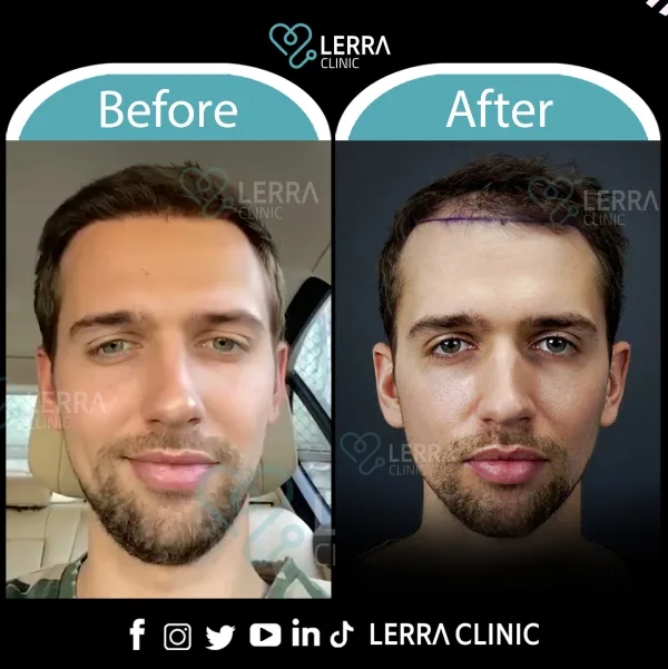 Before and After - Hair