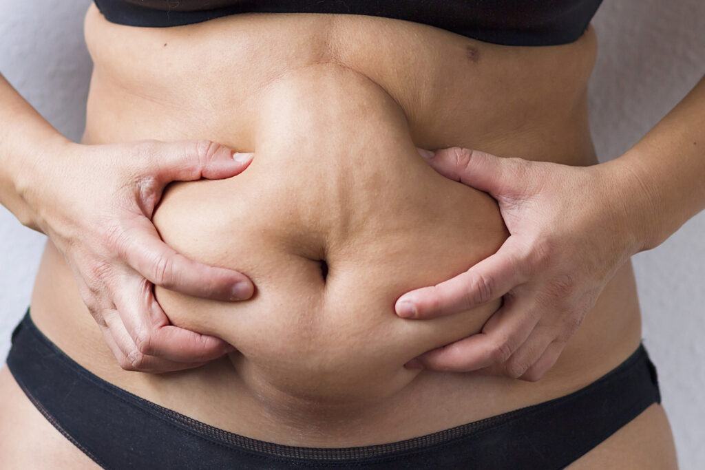 Abdominal Hardening After Liposuction