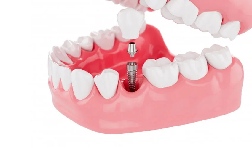Affordable Dental Implants in Turkey