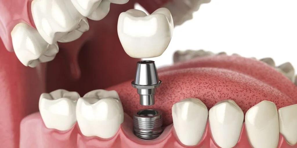 Affordable Dental Implants in Turkey