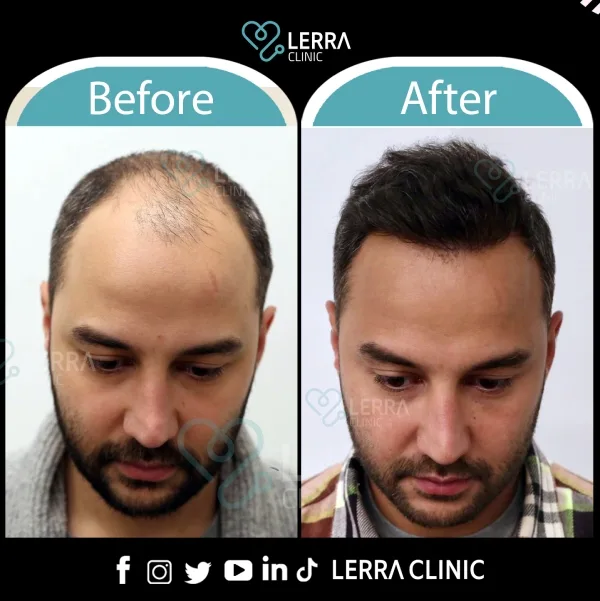 Before and After - Hair
