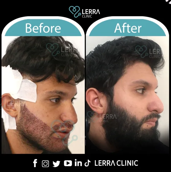 Before and After - Hair