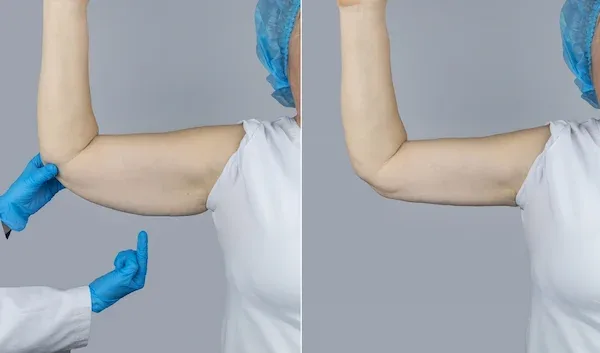Chirurgie de lifting des bras
