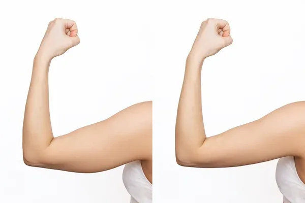 Chirurgie de lifting des bras
