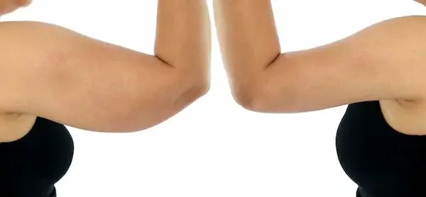 Chirurgie de lifting des bras