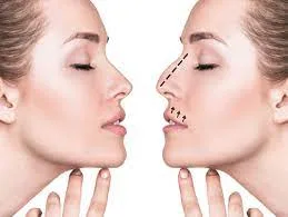 رحلة تجميل الأنف خطوة بخطوة مع ليرا كلينيك في اسطنبول