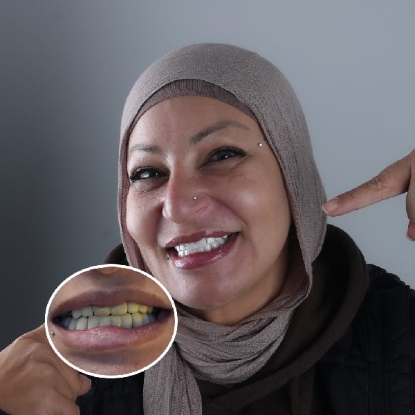 قبل و بعد - الأسنان