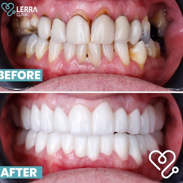 قبل و بعد - الأسنان