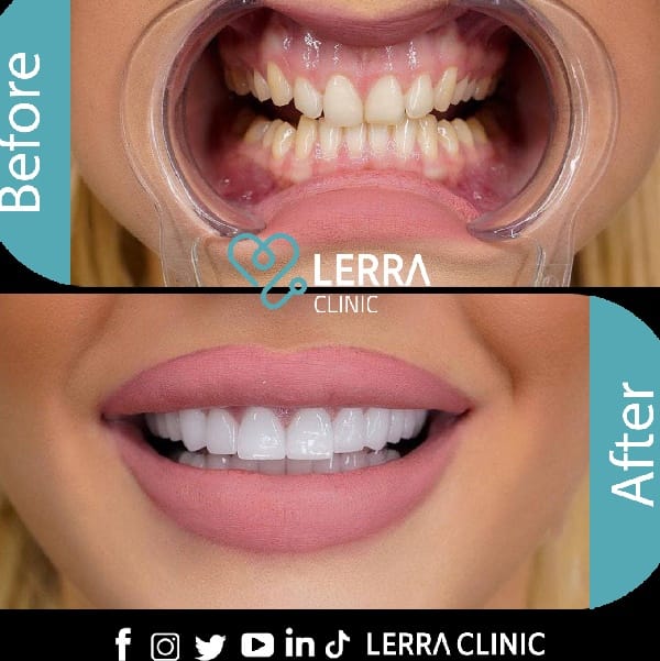 قبل و بعد - الأسنان