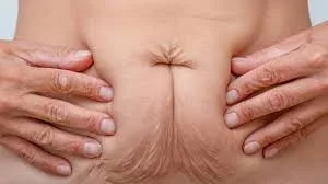 Postpartum Sagging Skin: Effective Cosmetic Solutions