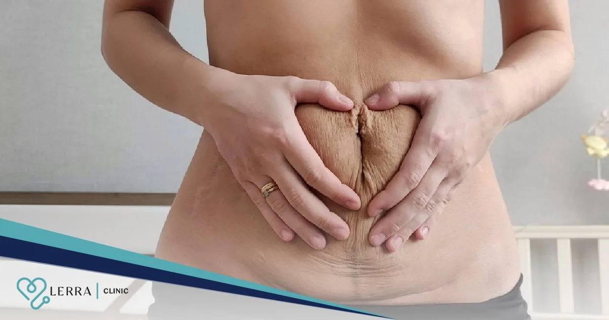 Postpartum Sagging Skin