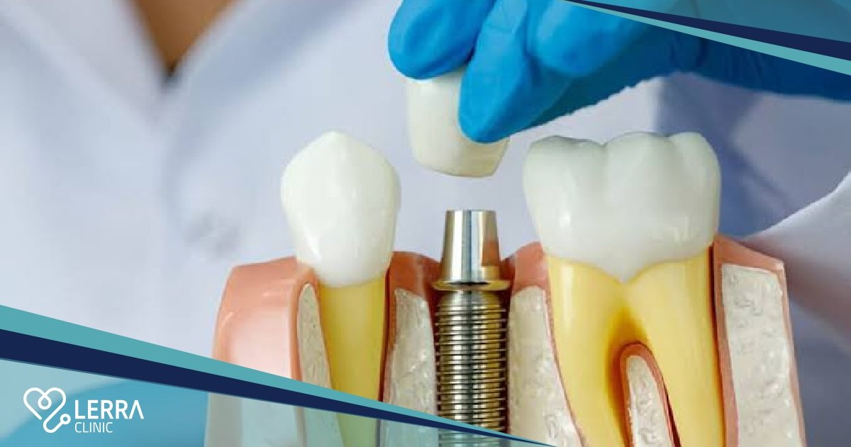 preparations-before-dental-implantation